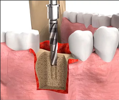 Импланты зубов в Краснодаре
